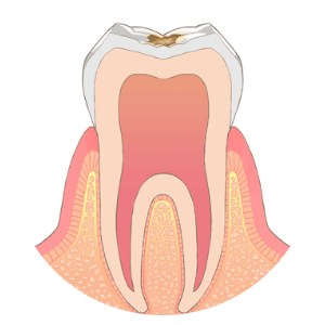 【見た目】歯の表面に白っぽい・茶色っぽいシミが見える