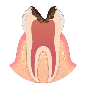 【見た目】歯ぐきより上の部分がほとんど残っていない状態（根だけが残っている状態）