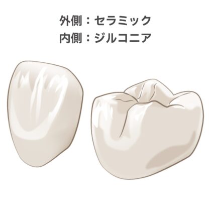 ジルコニアセラミッククラウン