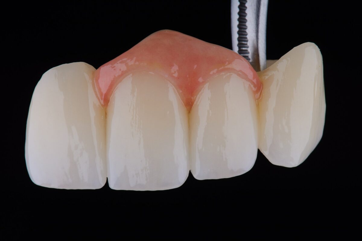 ラミネートベニア