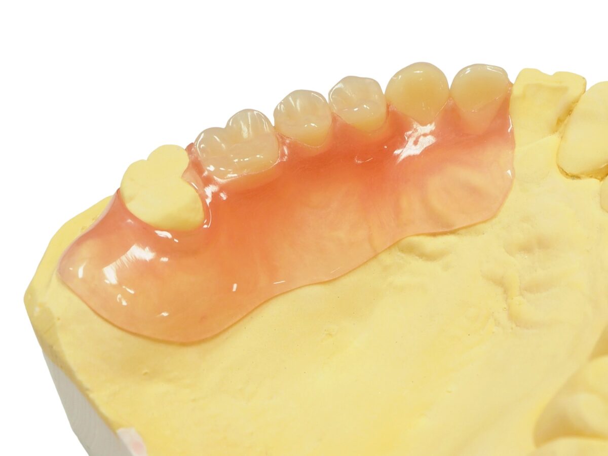 ノンクラスプデンチャー