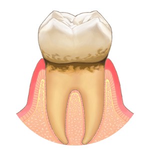歯肉炎（初期）