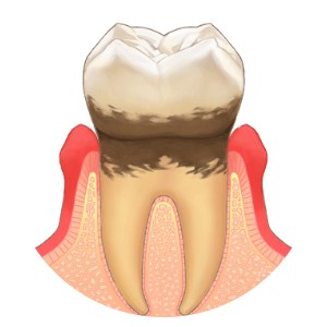 軽度歯周炎