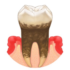 中度歯周炎