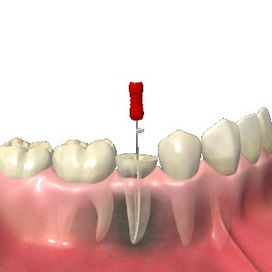 歯を残すための根管治療