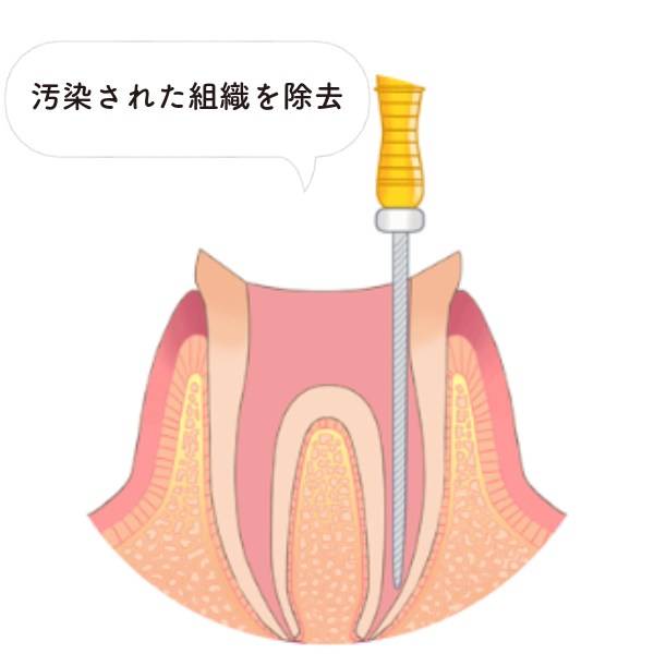 感染した神経や汚れの除去