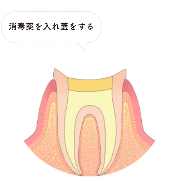洗浄・消毒（薬剤交換）