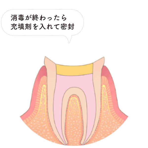 根管充填（薬剤で密封）